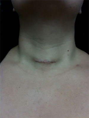 Locally Recurrent Thyroid Cancer