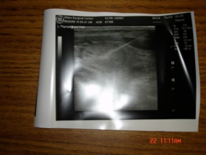 The needle can be seen in the nodule. A picture is obtain for the medical record